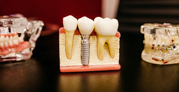prothesiste dentaire nice-prothese dentaire menton-prothese dentaire partielle mandelieu la napoule-prothese amovible cannes